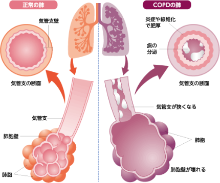 正常な肺とCOPDの肺